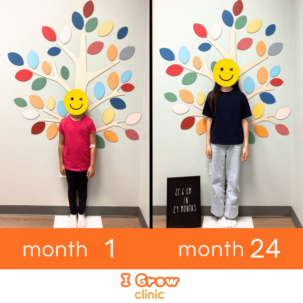 Before and after photos of a pediatric patient treated at I Grow Clinic, showing 22.6 cm of height gain over 24 months through supervised growth treatment.