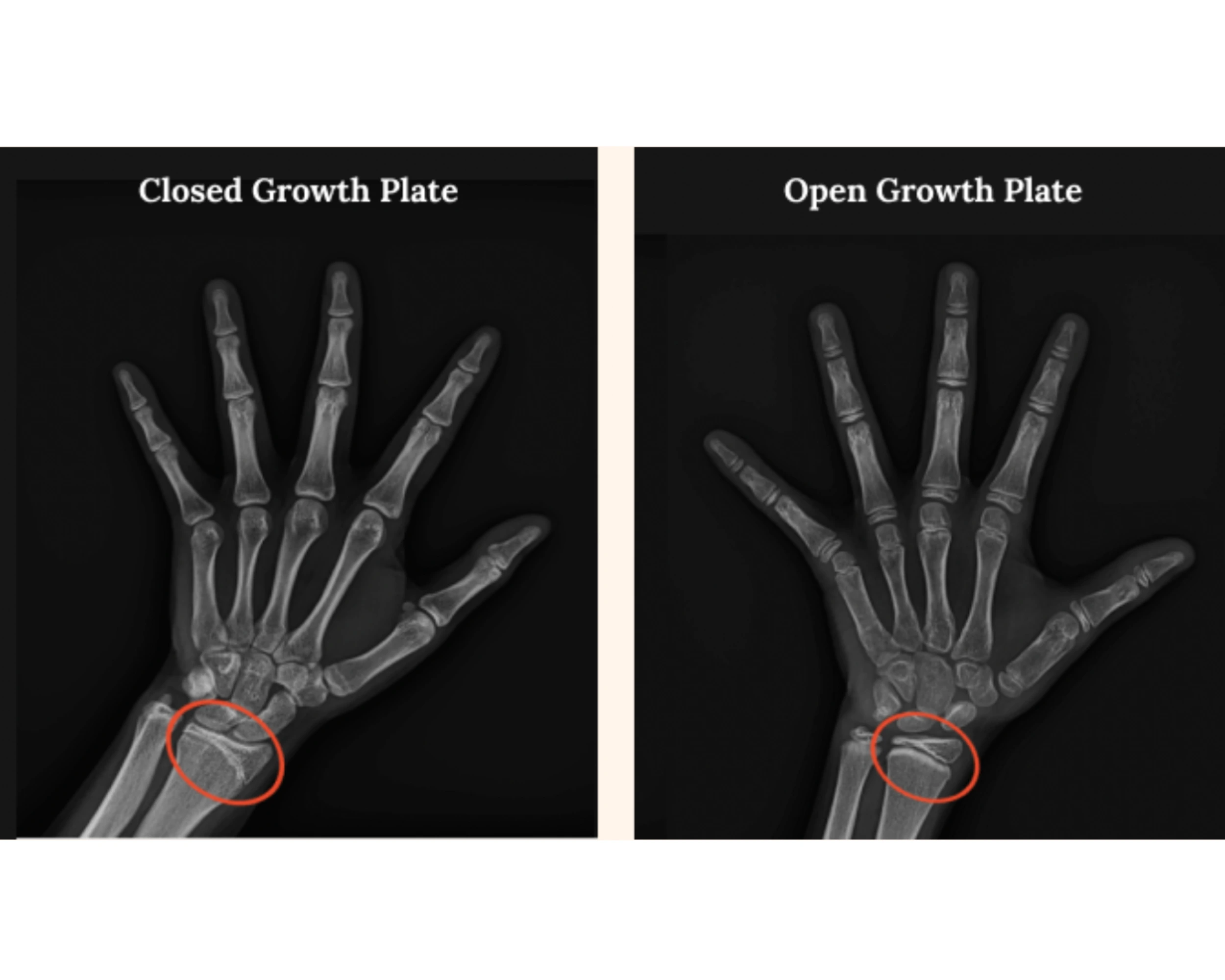 X-ray comparison showing open and closed growth plates in a childâ€™s hand, illustrating bone growth and closure.