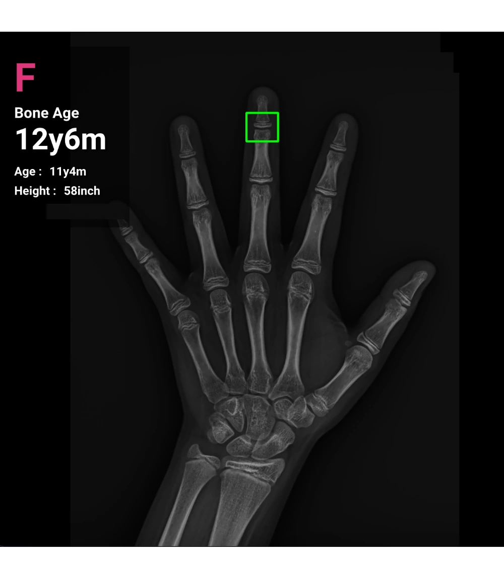 Hand X-ray showing bone age assessment used to evaluate a childâ€™s growth potential and remaining growth plates.