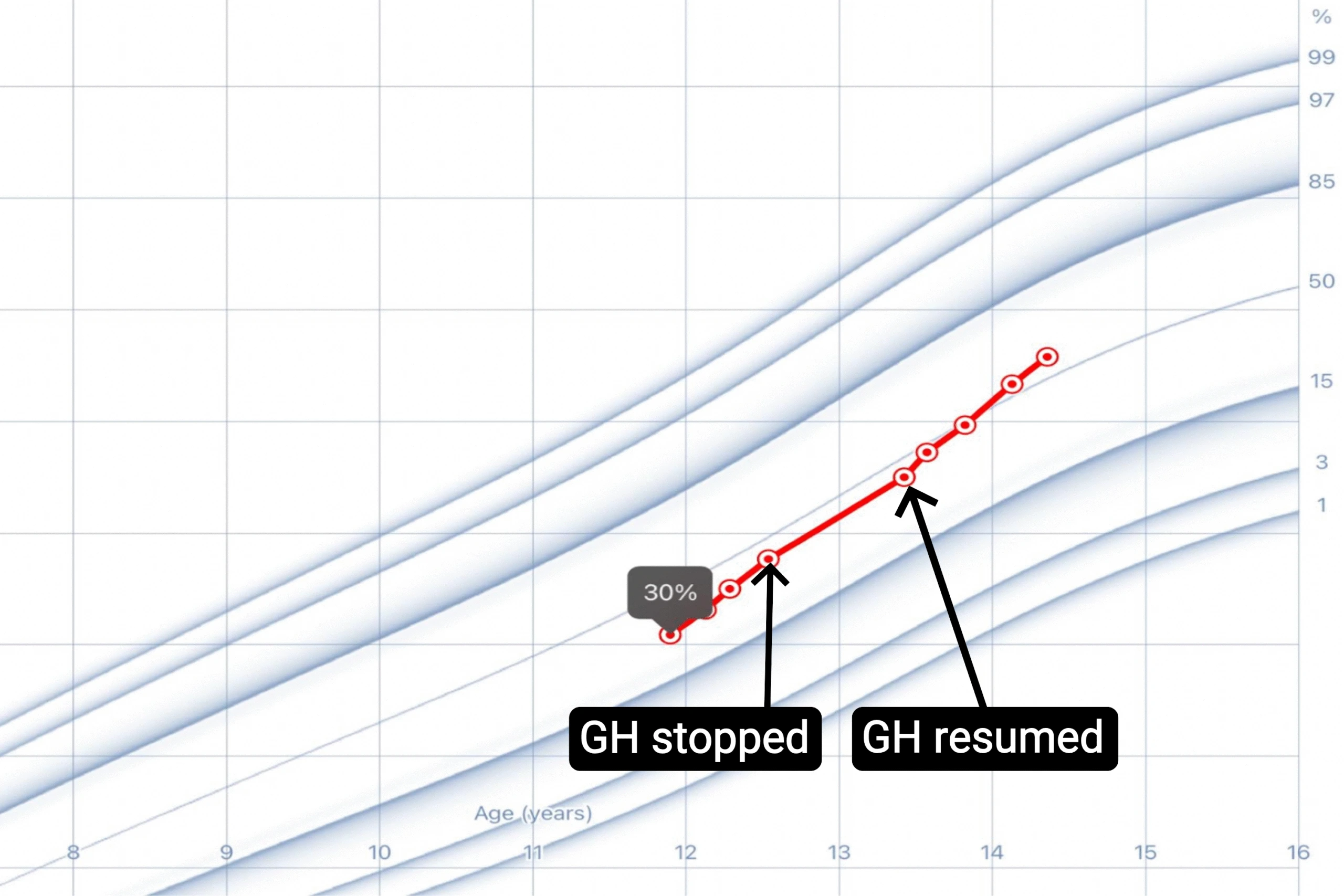 A pediatric growth chart showing steady height progression even during a one-year pause in growth hormone therapy between ages 12.5 and 13.5, demonstrating that the childâ€™s natural GH production remained active before treatment was resumed.