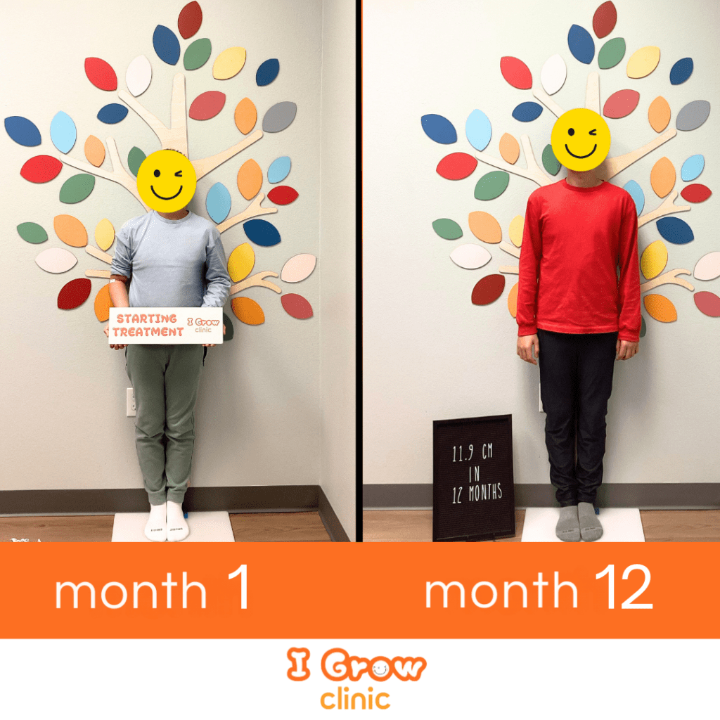 Before and after photos of a pediatric patient treated at I Grow Clinic, showing meaningful height gain achieved through growth hormone therapy while the growth plates were still active.