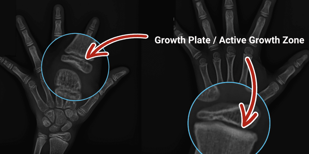 Annotated hand X-ray at I Grow Clinic showing the growth plate location with arrows pointing to the cartilage gap, the active growth zone where new bone cells are produced during childhood growth. 