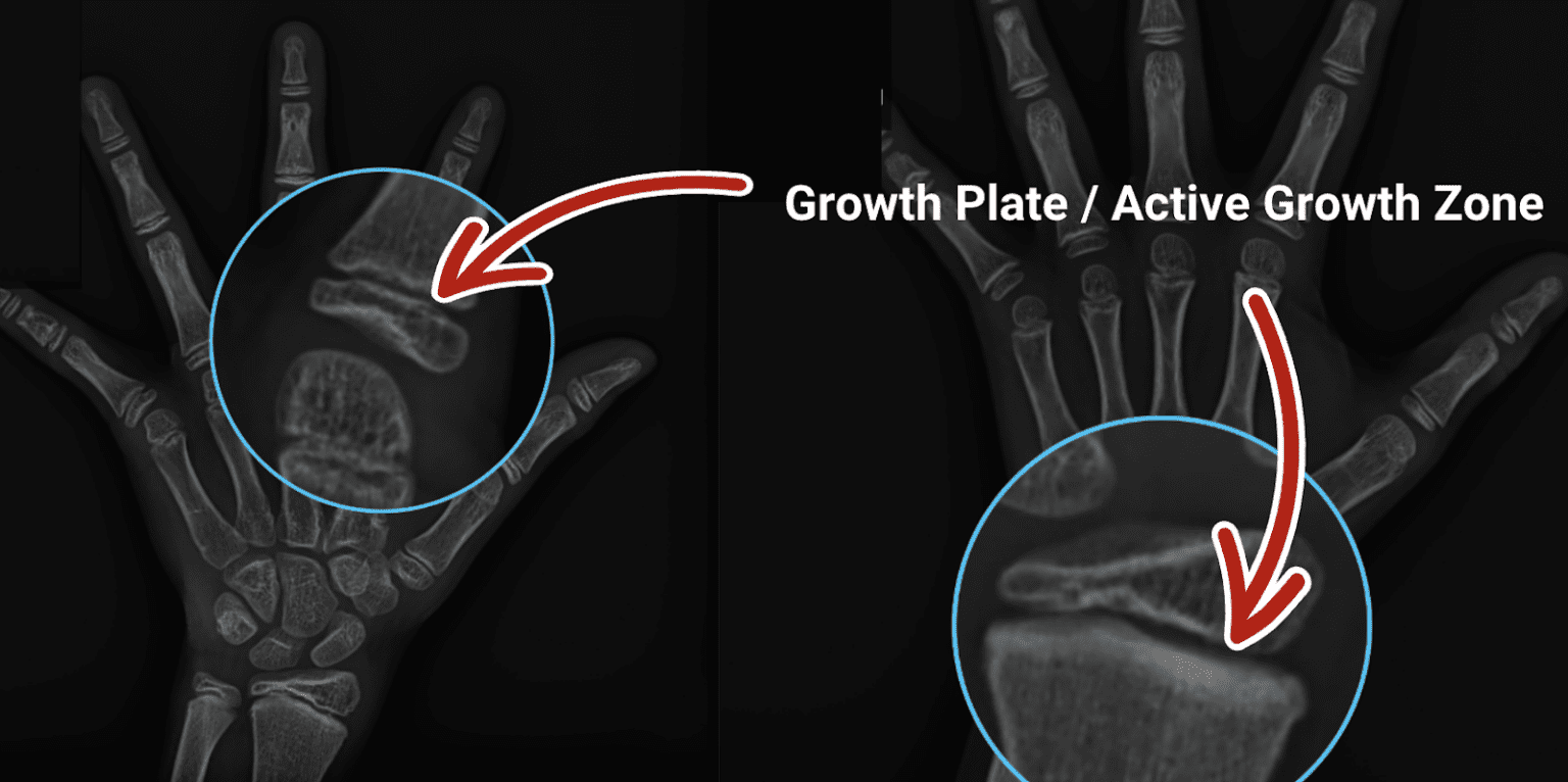 Growth Plate Chart.pdf Bone Age X-Ray: What Your Child's Growth Plate Results Actually Mean