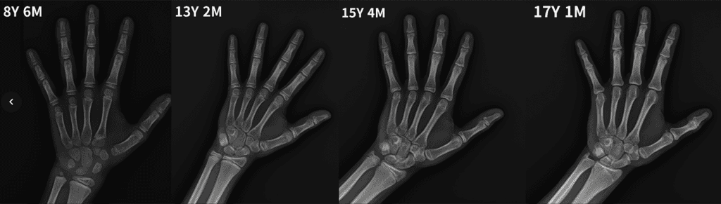 Bone age X-ray progression series showing four stages from bone age 8 years 6 months to 17 years 1 month, illustrating how growth plates narrow and fuse over time, used at I Grow Clinic to explain skeletal maturity to parents. 