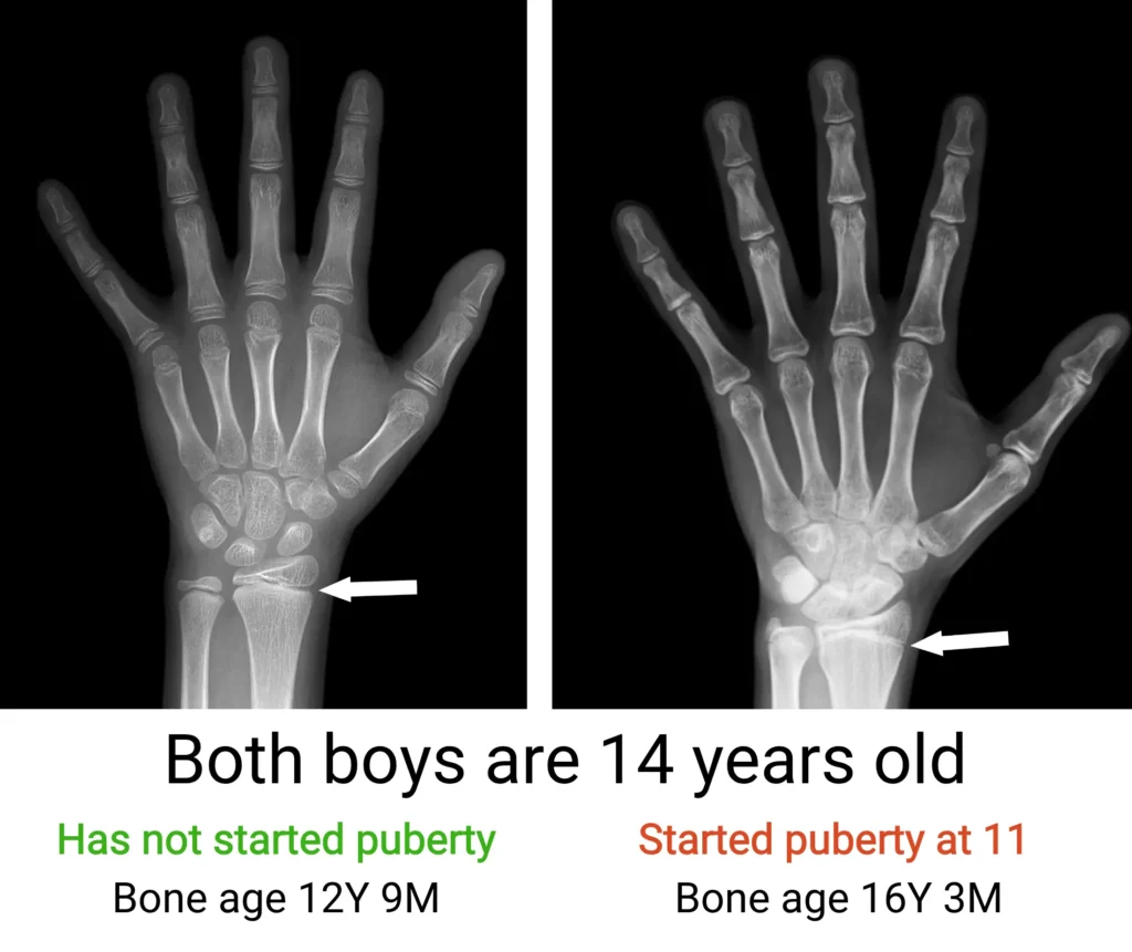 Side-by-side hand X-ray comparison of two 14-year-old boys at I Grow Clinic. The boy who started puberty at 11 has a bone age of 16 years 3 months, while the boy who has not yet started puberty has a bone age of 12 years 9 months, showing how early puberty accelerates bone maturation and compresses the growth window.