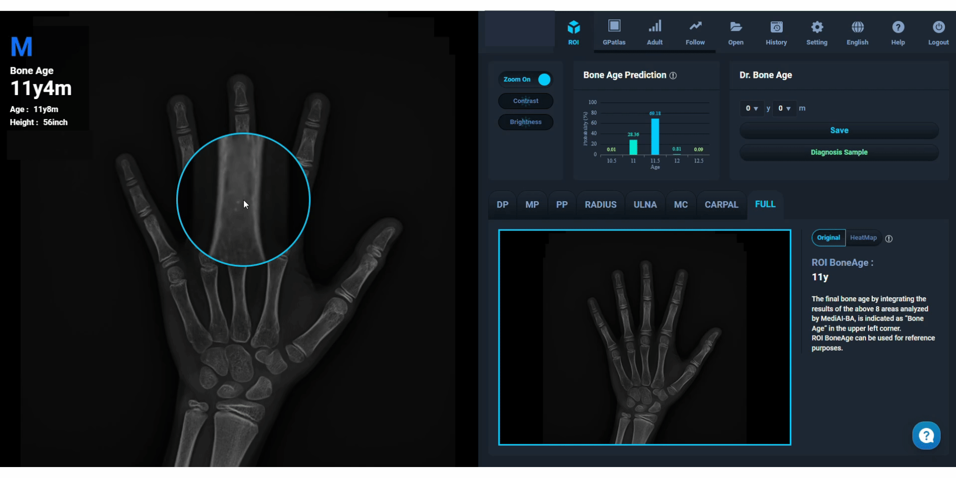 AI-driven bone age analysis software at I Grow Clinic measuring growth plate maturity to calculate predicted adult height for children with idiopathic short stature