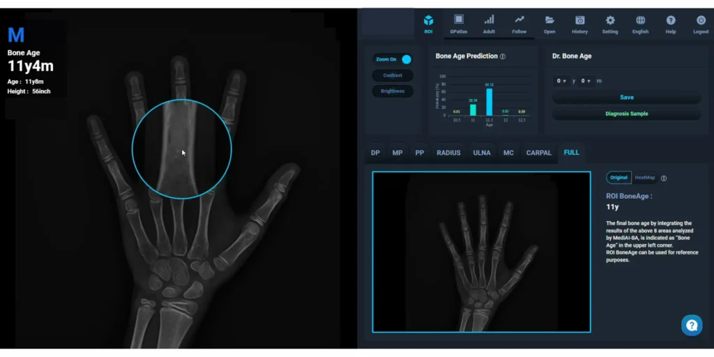 AI-driven bone age analysis at I Grow Clinic showing growth plate maturity assessment for a child with suspected early puberty, used to calculate remaining height potential.