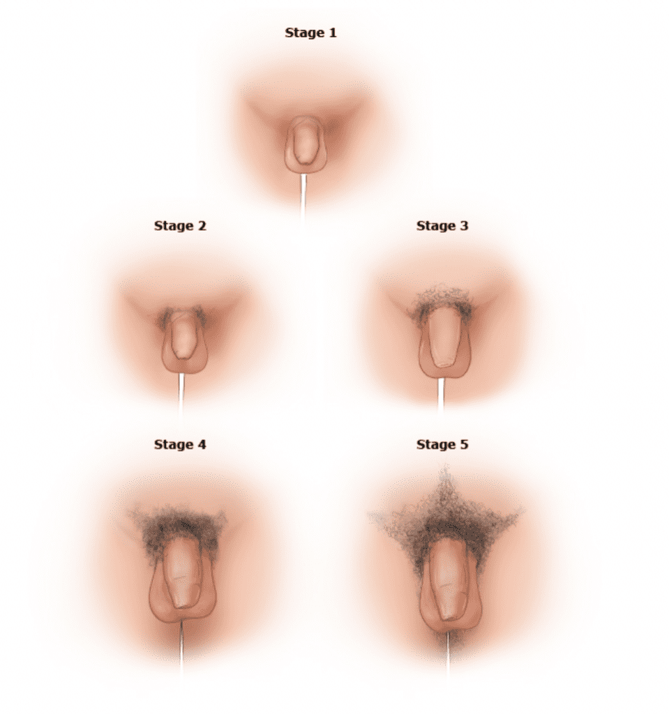 Tanner Stage 3 pubic hair development in a male, showing darker and curlier hair extending across the pubic area, corresponding to the peak of the growth spurt.