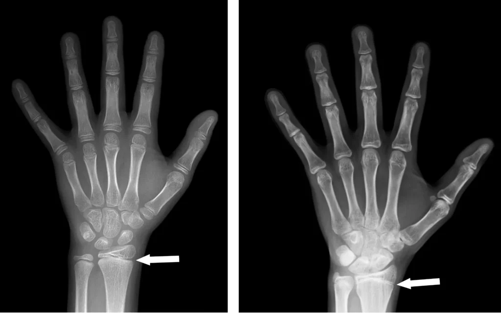 A hand and wrist bone age X-ray used to monitor growth plate maturation during puberty blocker treatment.