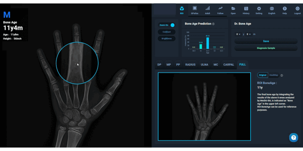 AI bone age analysis software showing a hand X-ray with predicted bone age and growth plate detail at I Grow Clinic.