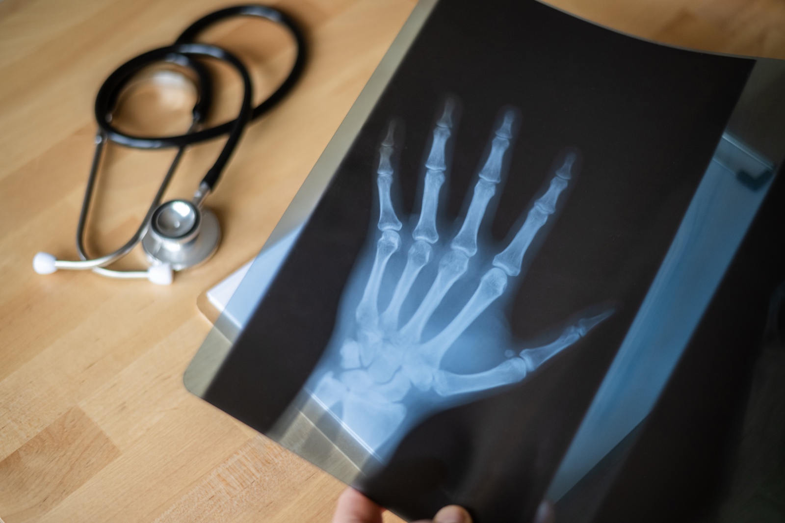 Hand X-ray image showing bone structure used in pediatric bone age evaluation
