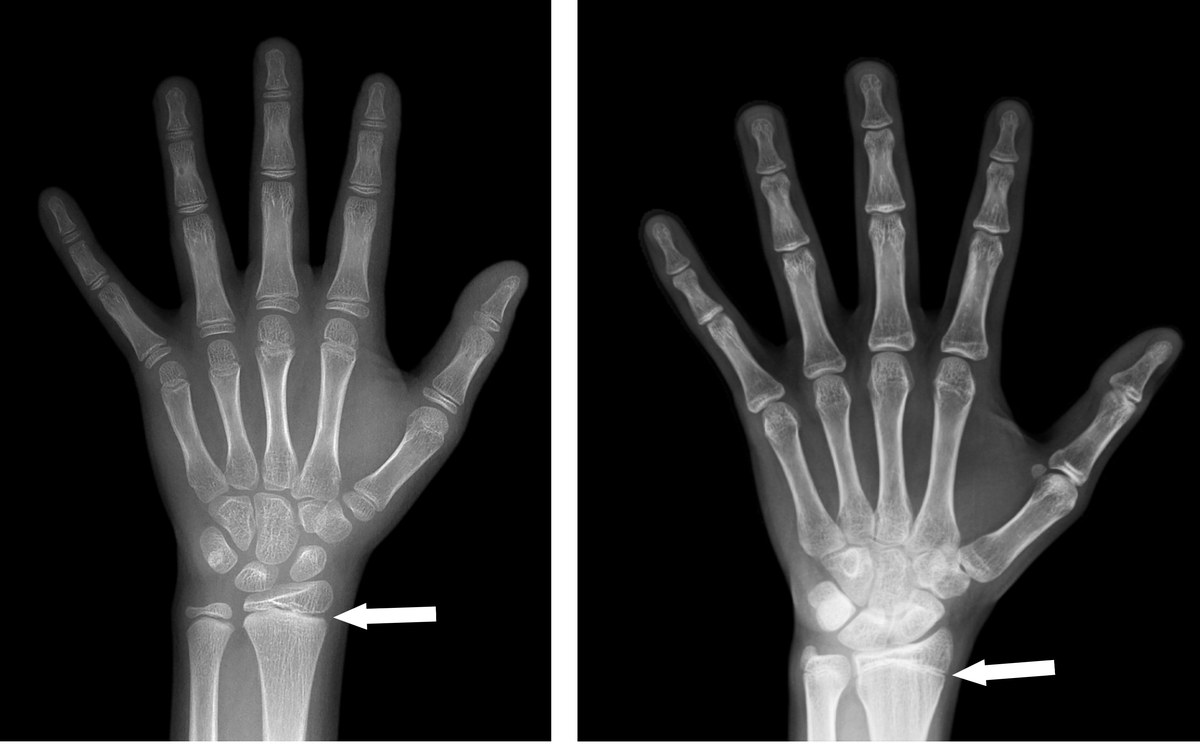 Side-by-side bone age X-ray comparison showing open growth plates versus closed growth plates in adolescent boys