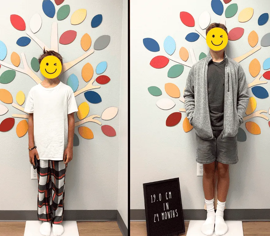 Growth hormone treatment before and after: I Grow Clinic patient height comparison