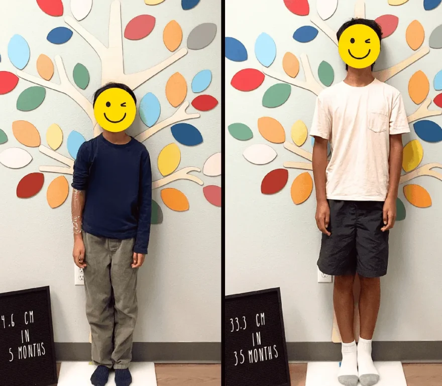 Growth hormone treatment for kids: before and after height progress at I Grow Clinic